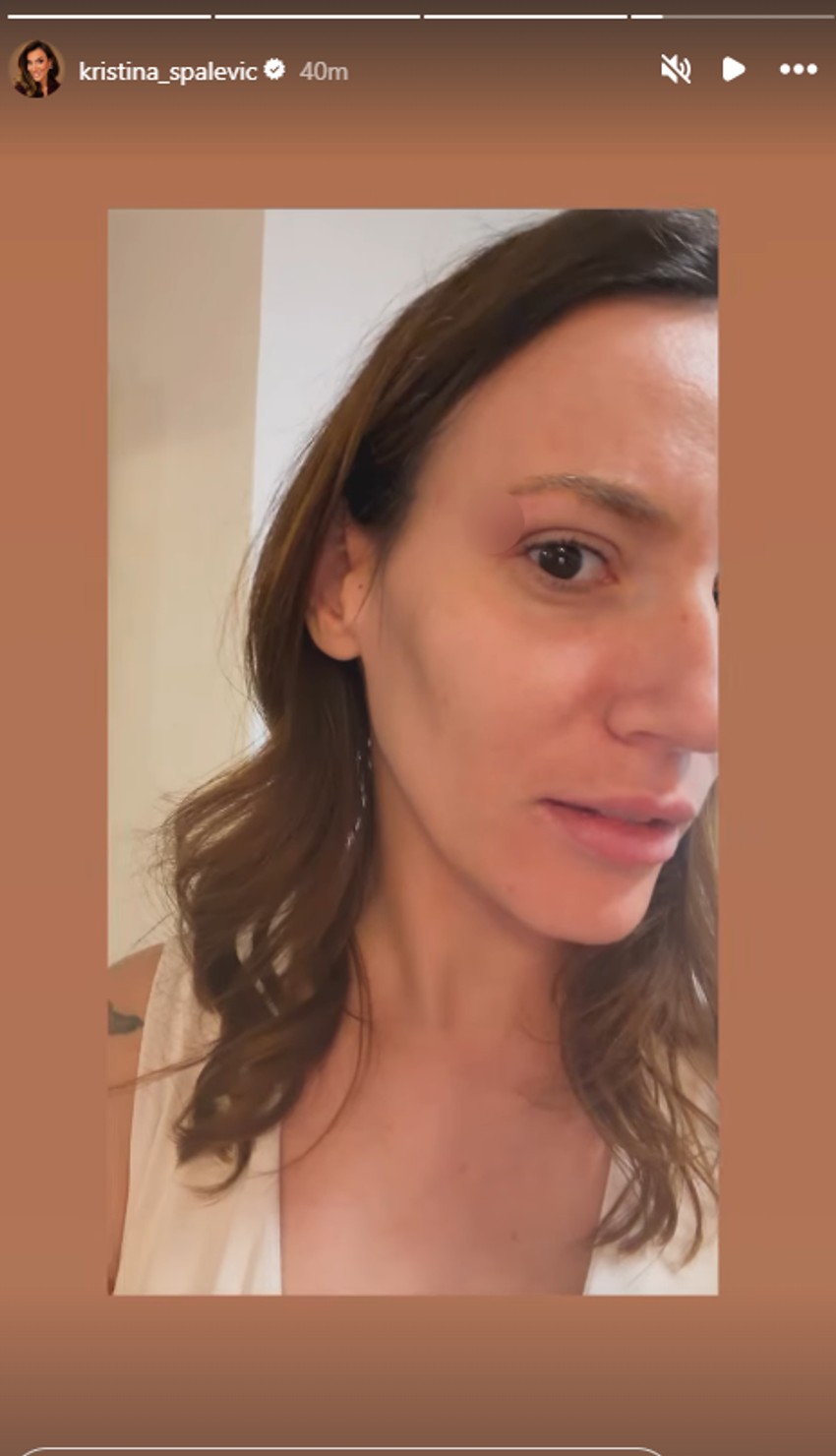 Kristina Spalević se oglasila i pokazala modricu: "Razvalio mi je arkadu"