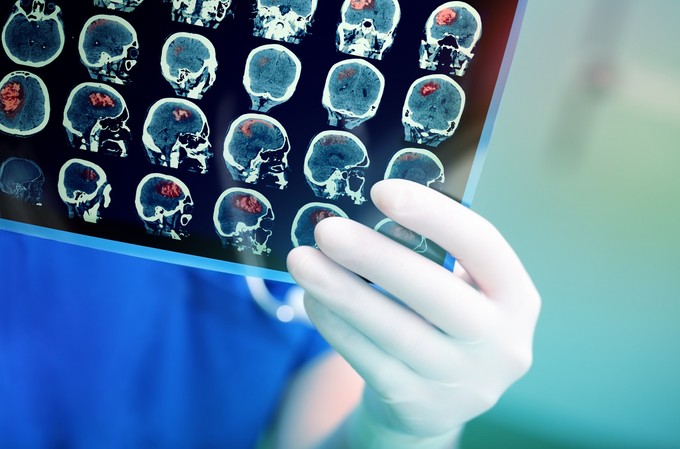 Ilyen módszerekkel ösztönözhető gyógyulásra stroke után az agy