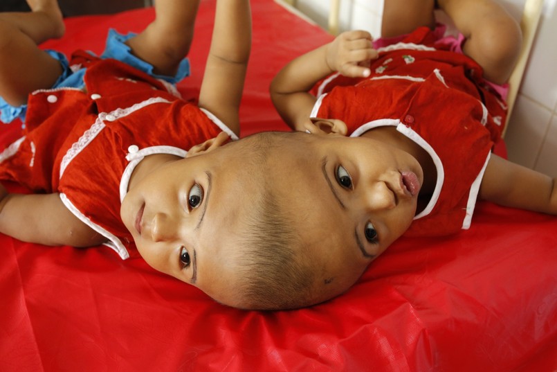 Rabeya Islam i Rokeya Islam leżą w szpitalu w stolicy Bangladeszu, Dhace. Czuwa przy nich ich mama, Taslima Khatun, z zawodu nauczycielka. Kobieta jest dobrej myśli i wierzy, że chirurgom uda się bez szwanku rozdzielić jej córki.