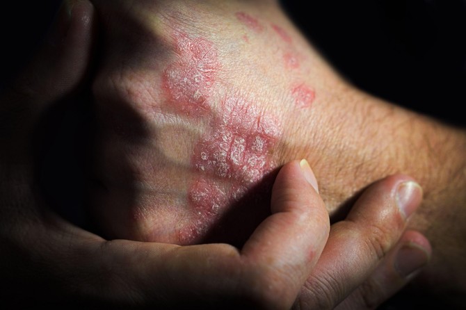 Posebno se muče oni sa psorijazom