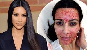 Kim K popularised vampire facials [Dailymail]