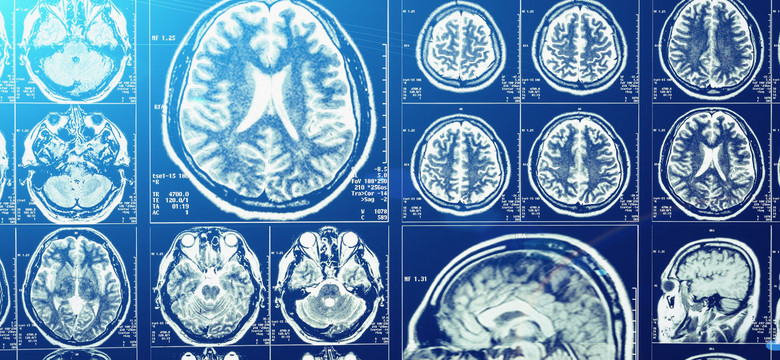 Choroby mózgu największym wyzwaniem opieki medycznej