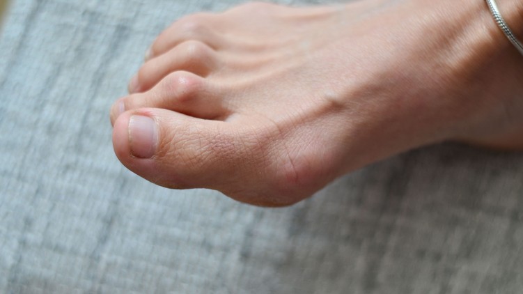 kalapácsujj lábfej izom egyensúly fizikoterápia