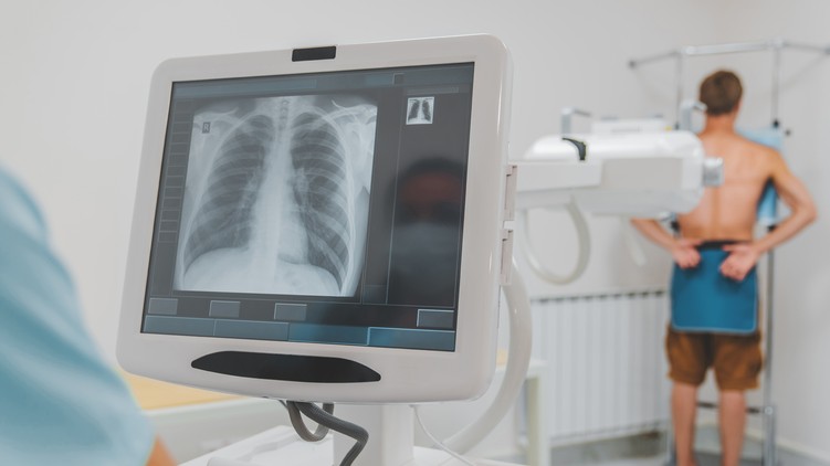 tüdőrák, daganatos betegségek, Rák világnapja, koronavírus, tüdőszűrés, szűrés