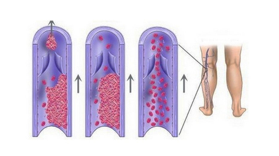 Vedd komolyan! Ez a vérrög kialakulásának 10 korai figyelmeztető jele