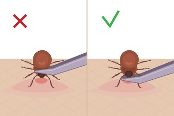 Hogyan kell kiszedni helyesen a kullancsot? Semmiképp se csavarja!