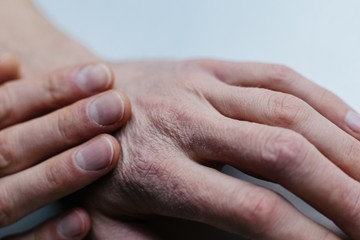 Telente száraz, cserepes a keze? Ezt tanácsolja a bőrgyógyász