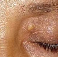 xanthelasma-d0000124C3ffe5165525f