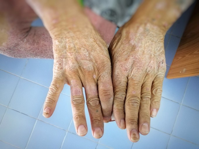 Kemény, érdes bőr: nem szimpla bőrbetegség, ha scleroderma okozza