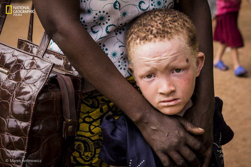 Ludzie duchy - jak bielactwo determinuje życie w Tanzanii