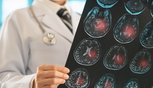 Lakunarni moždani udar  je po život opasno medicinsko stanje 