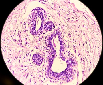 Hidradenitis suppurativa mikroszkópos képe a hónalji tömegszövetekben. a tüszőhám hiperpláziája, bőrgyulladásos sejtes infiltrátum jelenlétében.