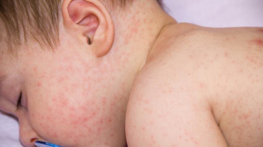 Mi okozza a kiütéseket a csecsemő bőrén? - EgészségKalauz