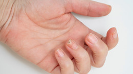 Grzybica paznokcia u rąk - jak się pozbyć wstydliwego problemu i jak zapobiegać?