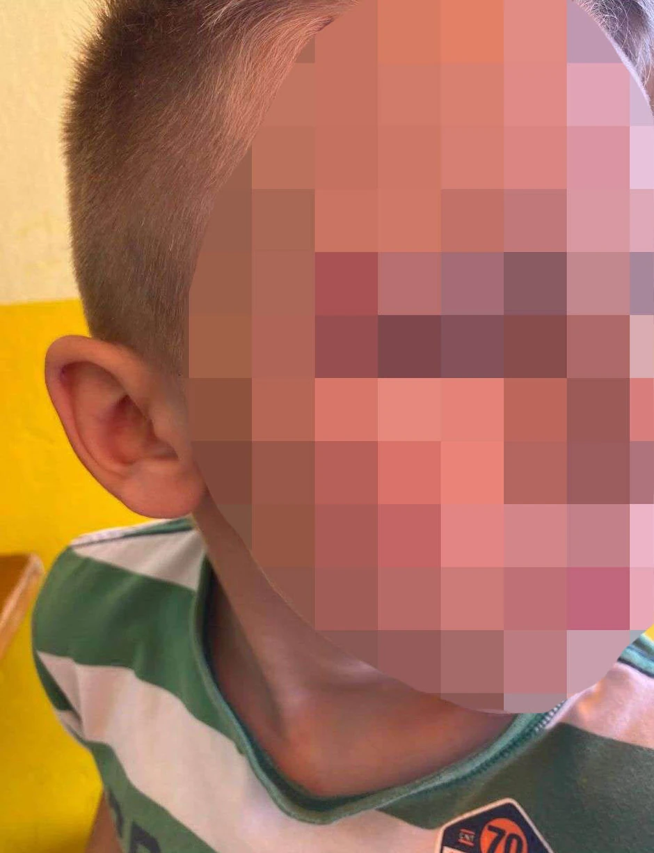 Fotografija povreda dečaka koje nam je dostavila njegova majka