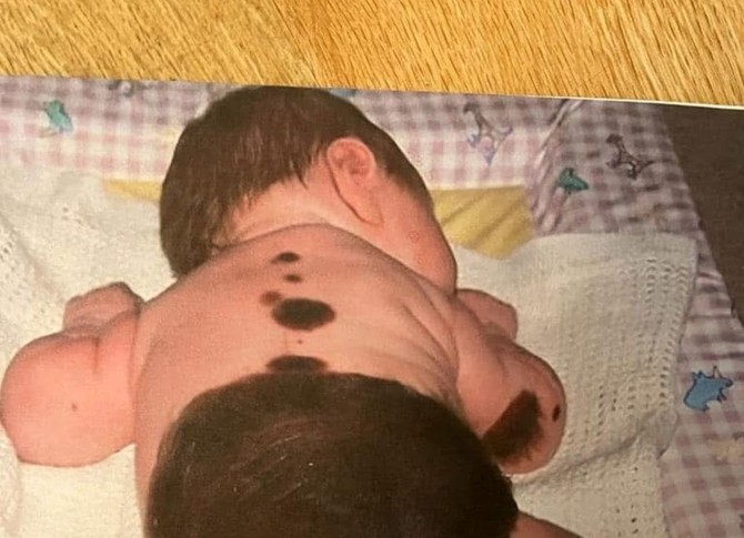 Rođena je sa brojnim mladežima, a najveći od njih prekriva veliki deo njenih leđa