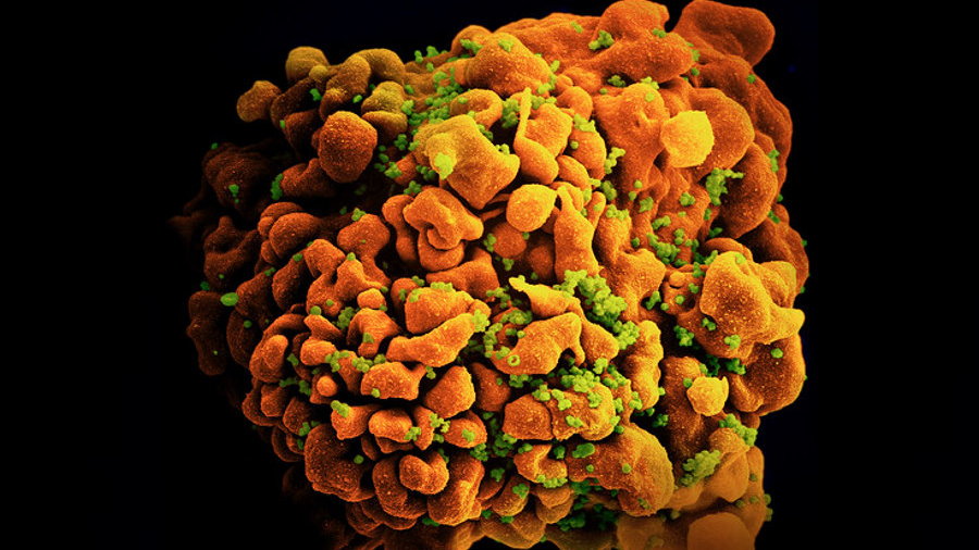 Obraz ze skaningowego mikroskopu elektronowego przedstawiający zakażony wirusem HIV limfocyt T, fot. CC BY 2.0/ NIAID/ Flickr