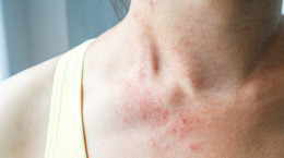 Symptoms of coronavirus on the skin.  Infected people may develop a rash