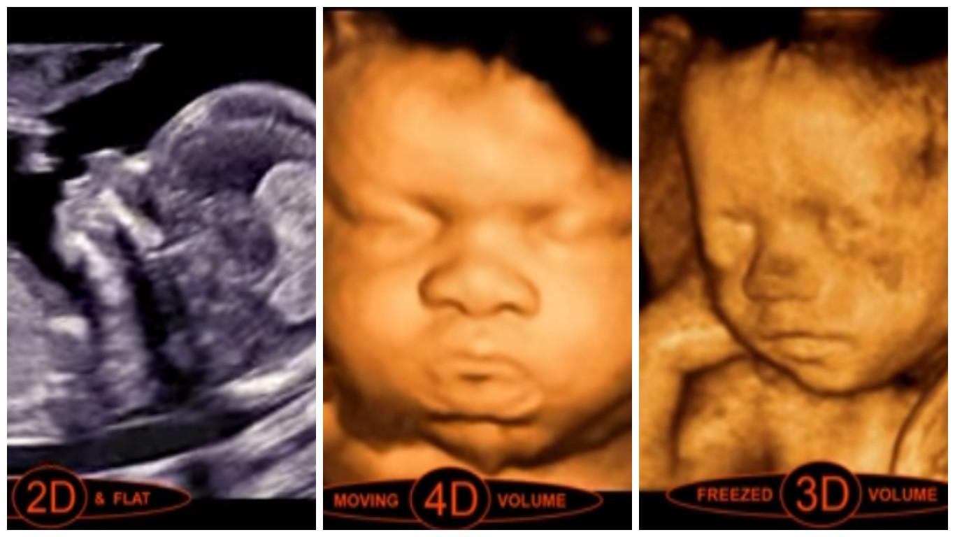 Aký je rozdiel medzi 2D, 3D a 4D ultrazvukom? Video, ktoré vám to vysvetlí  | Najmama.sk