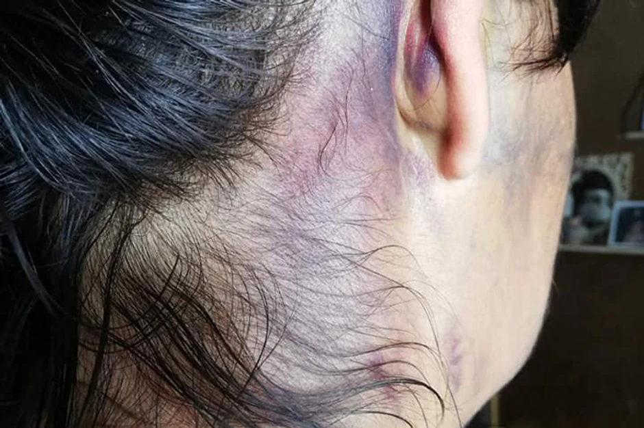 Podlivi i masnice nalaze joj se po celom telu