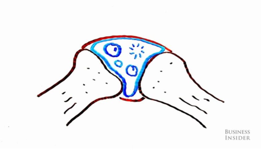 U sinovijalnoj tečnosti stvaraju se mehurići koji pucaju prilikom krckanja prstiju