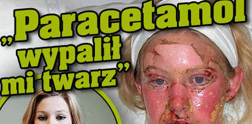 "Paracetamol wypalił mi twarz"