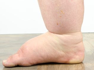 Słoniowacizna (łac. elephantiasis)