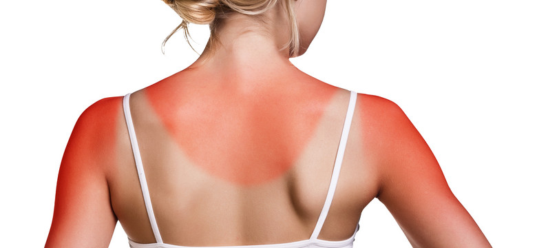 Oparzenia słoneczne – gdy skóra woła o pomoc