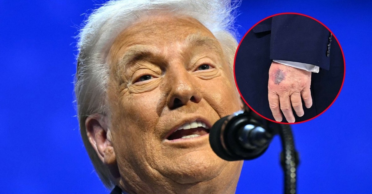 Czy Donald Trump jest chory? Nowe zdjęcia wywołały falę spekulacji o stan zdrowia