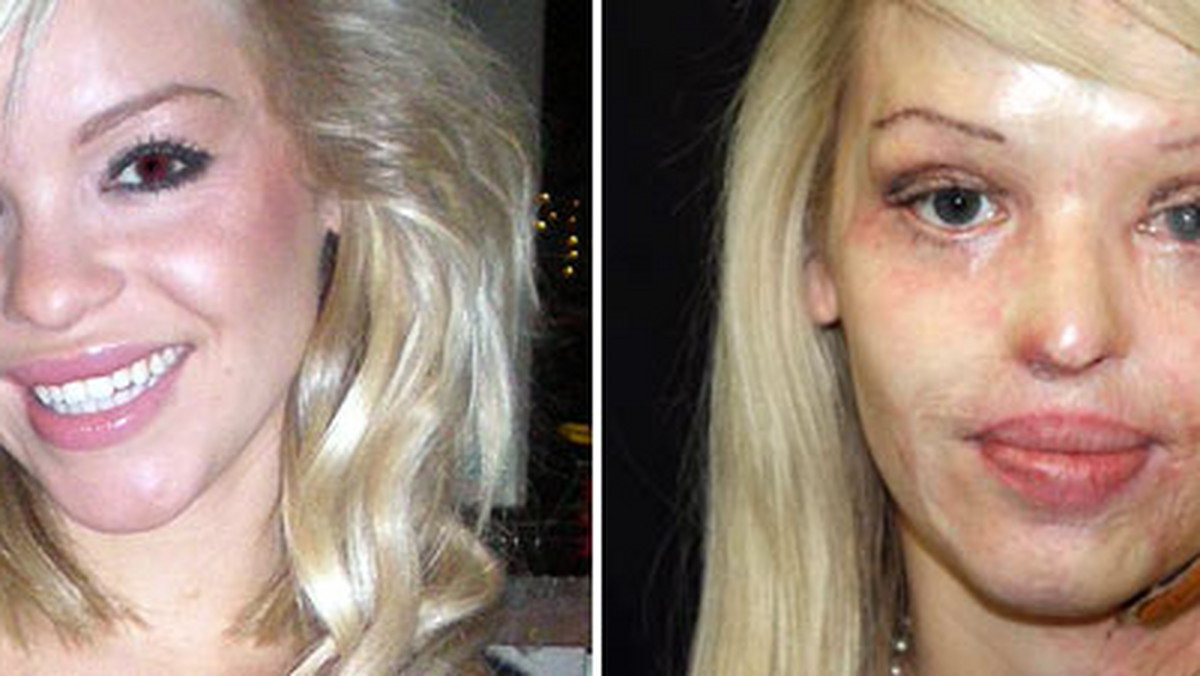Cztery lata temu modelka Katie Piper została brutalnie okaleczona - napastnik oblał ją żrącym kwasem. Przeszła już 111 operacji, a dzięki ostatniej być może odzyska wzrok w lewym oku.