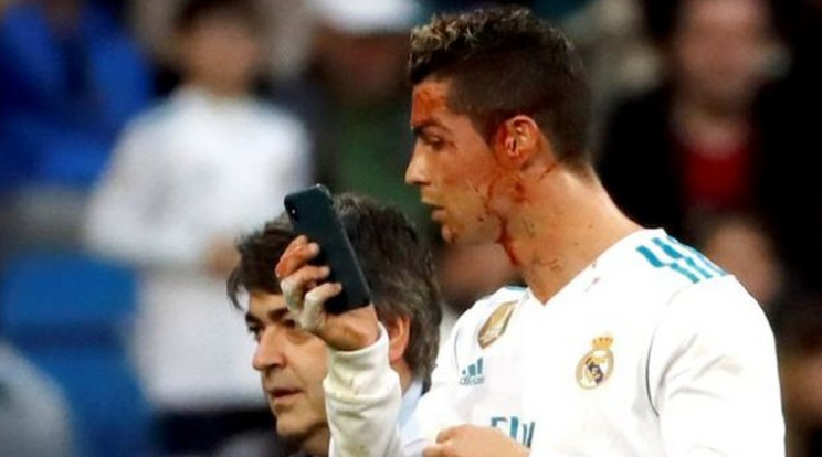 A focista nem
bírta ki az öltözőig, egy
telefon kameráján azonnal
ellenőrizte,
hogy fest
vérző fejjel