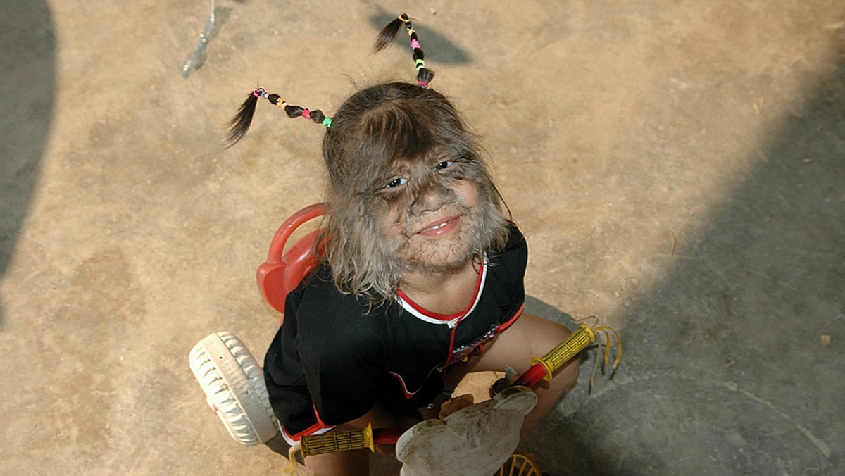 11-letnia Supatra Sasuphan z Tajlandii, która cierpi na syndrom Ambras, zwany też syndromem wilkołaka trafiła do Księgi Rekordów Guinnessa jako "Najbardziej owłosiona dziewczynka na świecie" - donosi serwis huffingtonpost.com.