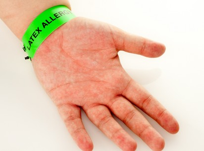 Latex allergia
