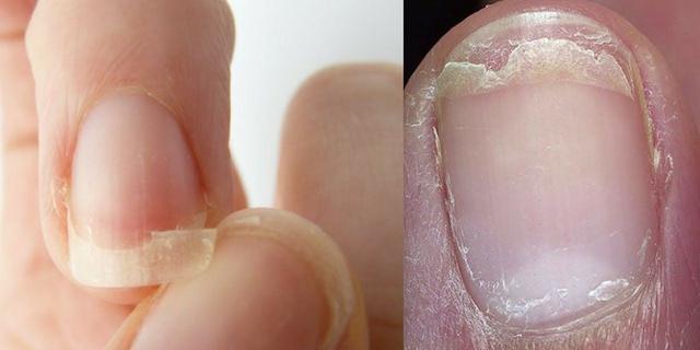Brittle Nails: How you can naturally treat this disorder | Pulse Nigeria