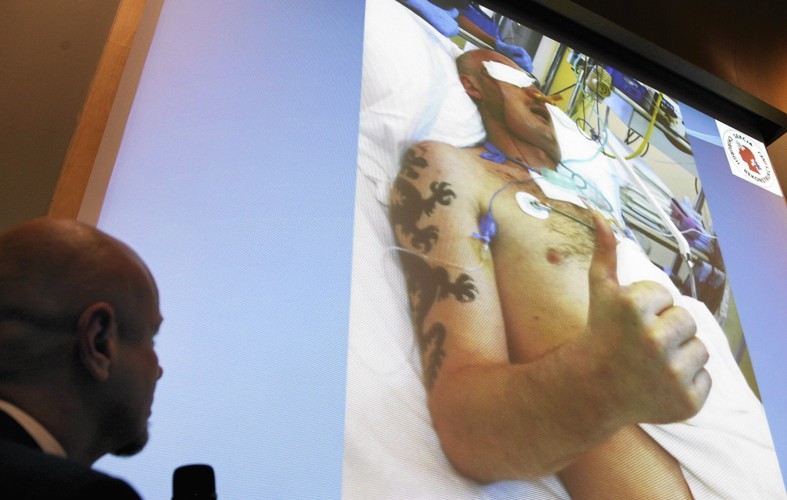 Pierwszy w Polsce pacjent po przeszczepie twarzy