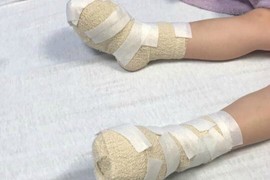 Stigla je na plažu, okrenula se na sekund i čula JEZIV VRISAK svoje ćerkice: Stopala su joj cela bila U PLIKOVIMA - i ovo može svakome da se desi