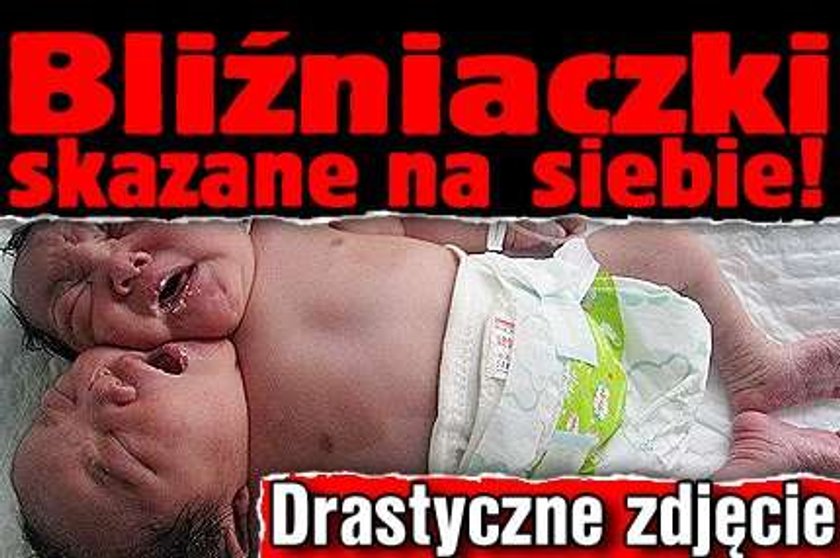 Bliźniaczki skazane na siebie! Drastyczne zdjęcie