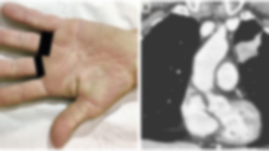 Dziwne zmiany na dłoniach. Nietypowy objaw raka płuc