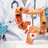 Rak debelog creva sve češće se beleži kod mlađih od 50 godina