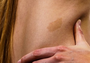 Ova hiperpigmentacija nastaje kada telo proizvodi višak melanina