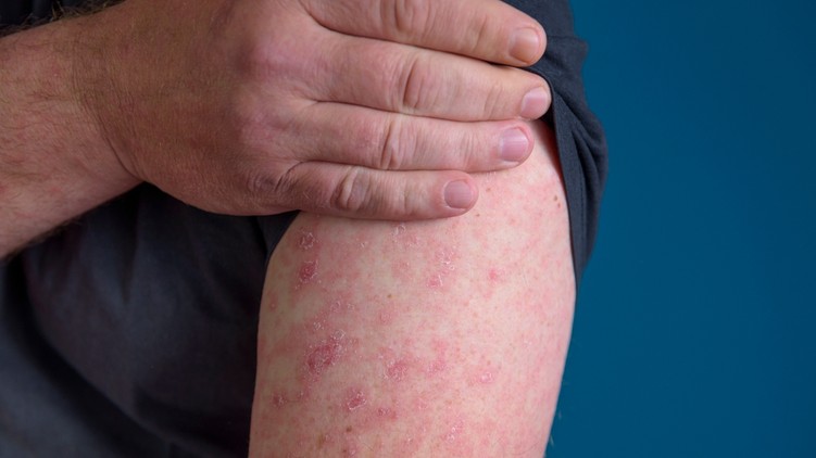 scleroderma kötőszövet betegség tünetei