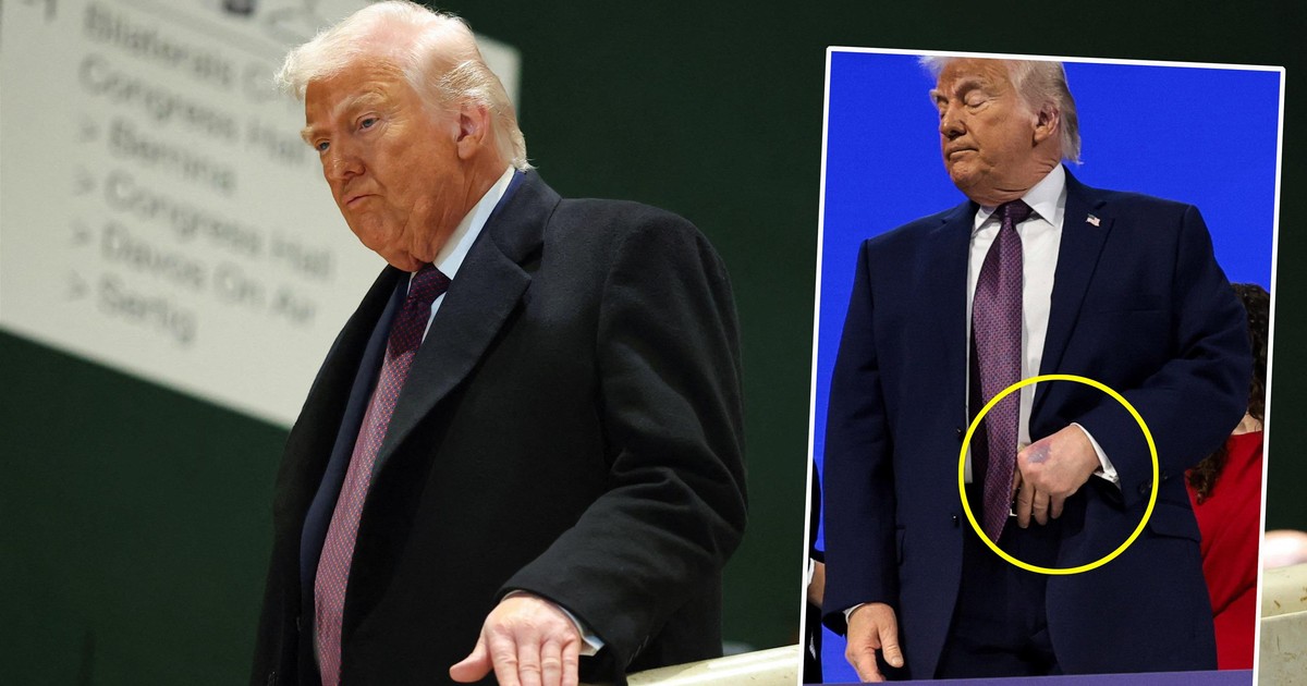 Wielki siniak na dłoni Trumpa. Biały Dom wyjaśnia – to nie przez uściski dłoni