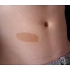Birthmark on stomach [DermatologyConsulting]