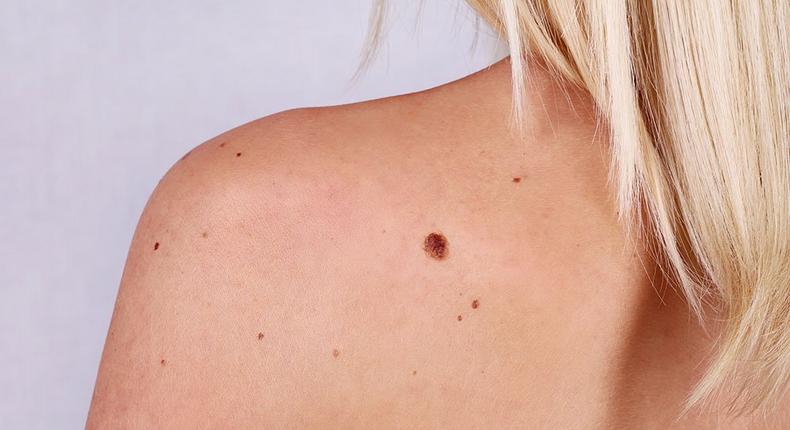 skin cancer causes surprising