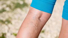 Varicose veins