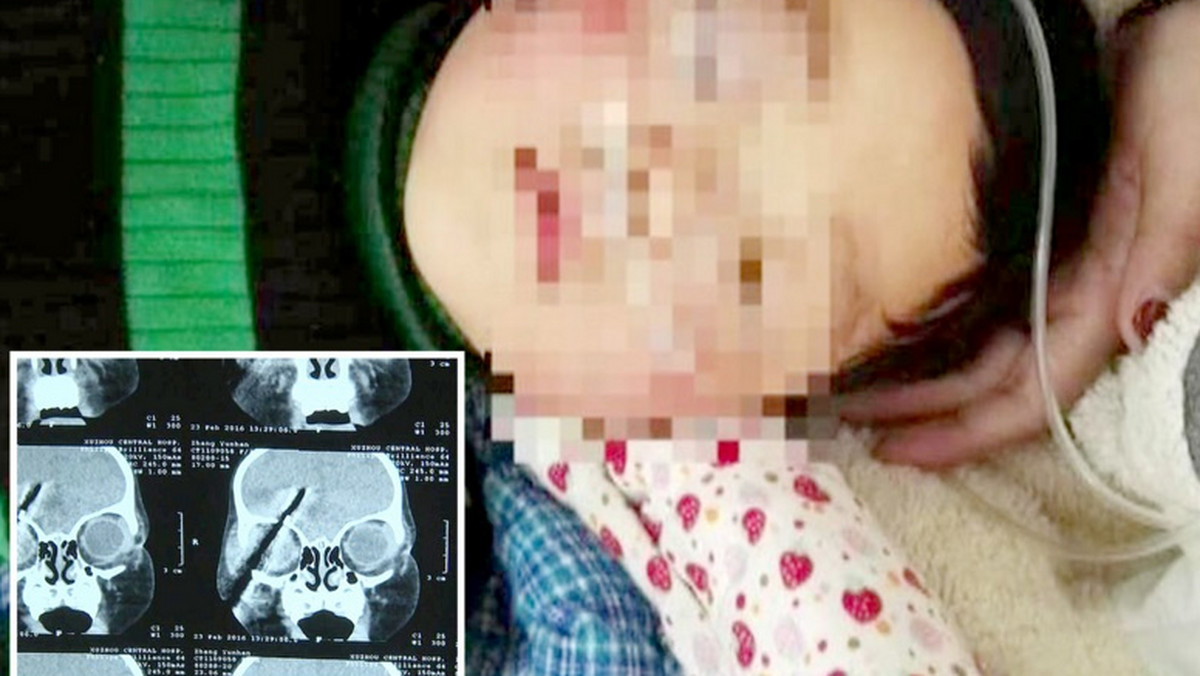 Han Han to roczna dziewczynka z Chin, która wbiła sobie śrubokręt w czaszkę. Ogromny ból spowodował, że dziecko straciło przytomność i zostało przewiezione do szpitala.