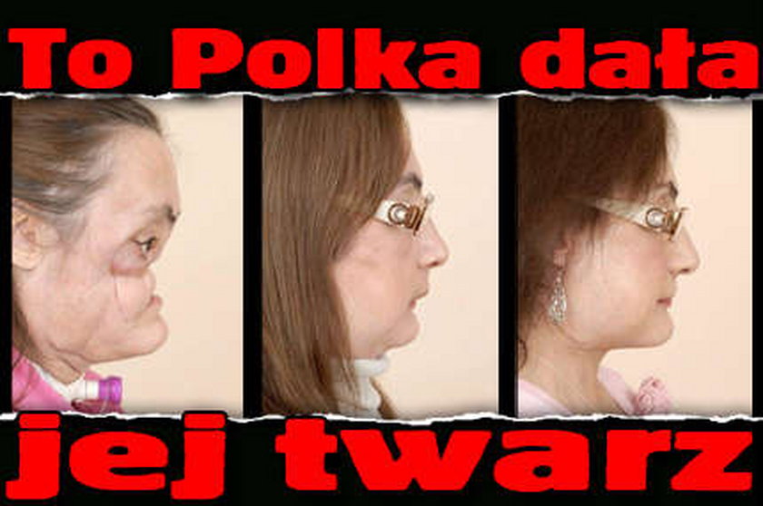 Mąż strzelił jej w głowę. Polka dała jej nową twarz!