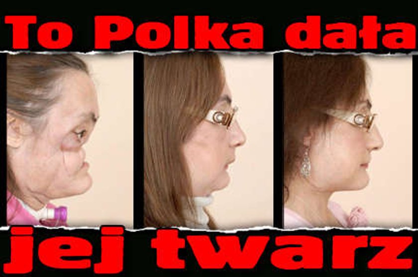 Mąż strzelił jej w głowę. Polka dała jej nową twarz!