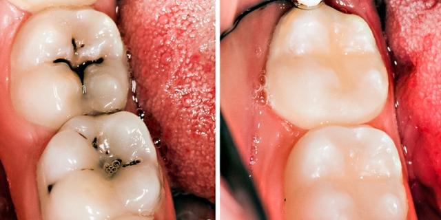 3 home remedies for tooth decay and cavities