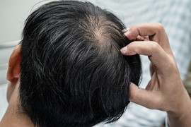 Otišao u Tursku na TRANSPLANTACIJU KOSE, UMRO 4 dana posle intervencije - vlasti pokrenule ISTRAGU: Odlaze da se podmlade i ulepšaju, vraćaju se sa GNOJIM RANAMA I UMIRU U MUKAMA